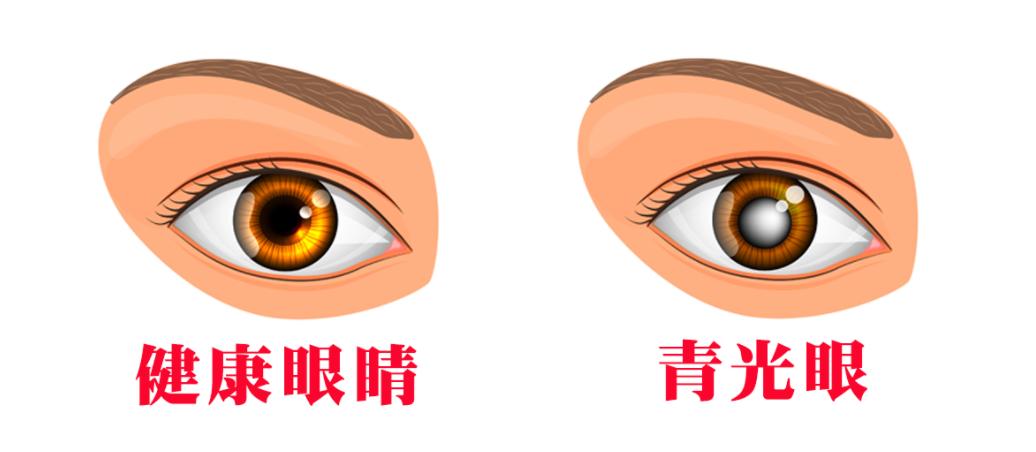 瞳中暗影：青光眼的静默诗行