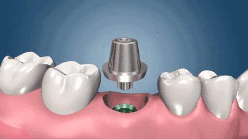当牙齿离家出走后,我用种植牙给嘴巴安了个 “新邻居”