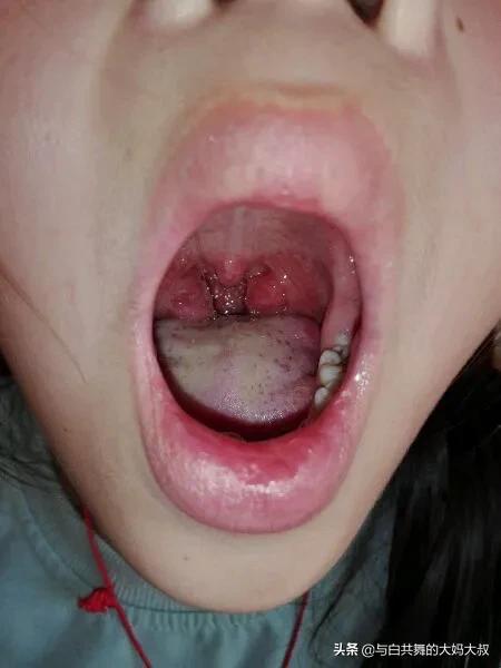 喉咙里的小火山