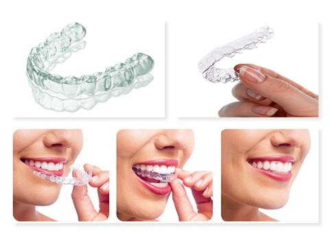 隐形矫正：重塑笑容的无声革命