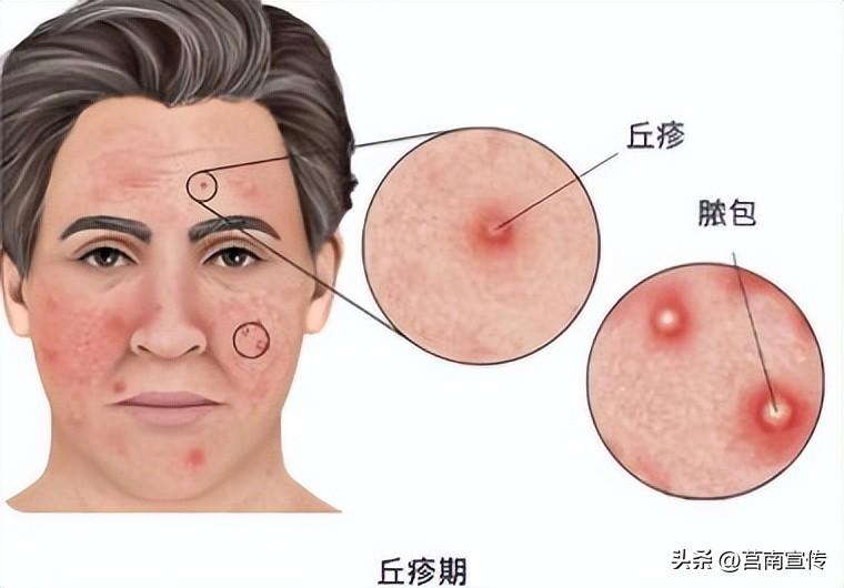 那些年，我与痘痘的漫长周旋