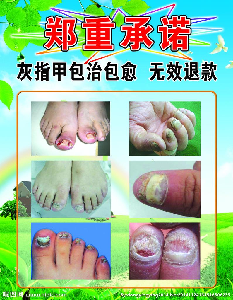 灰指甲：被轻视的指甲健康警报