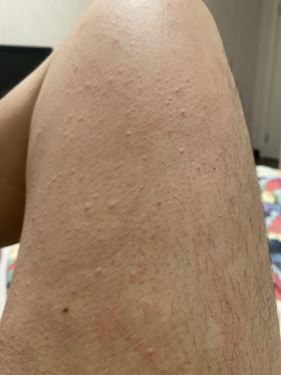 皮肤上的 “神秘风疹”:解码荨麻疹的来龙去脉