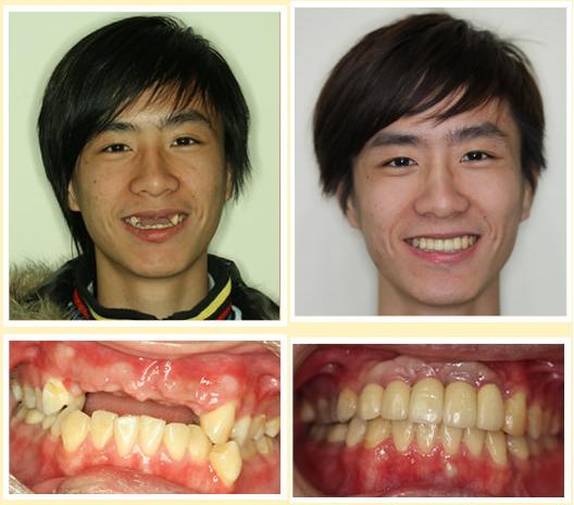 缺牙别将就，种植牙可能是你牙齿的 “第二春”