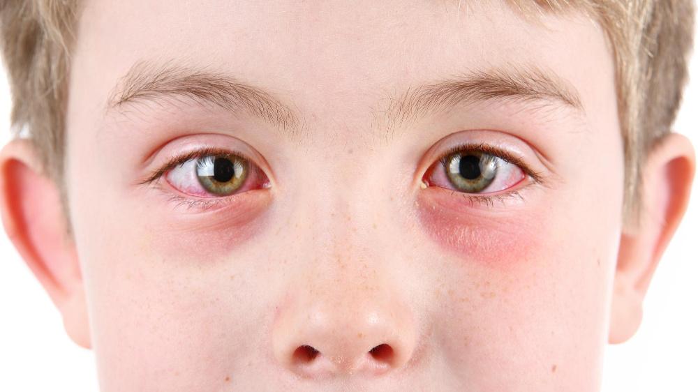 眼眸里的红潮:那些被结膜炎偷走的晨昏