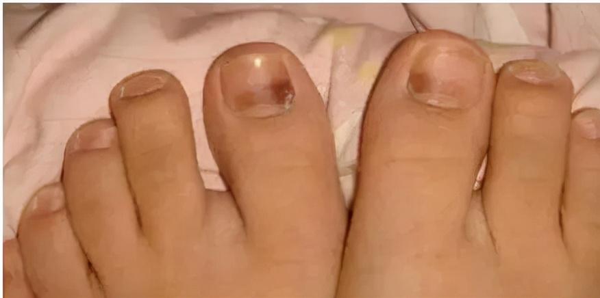 指甲上的 “灰色警报”：被误解的真菌感染真相