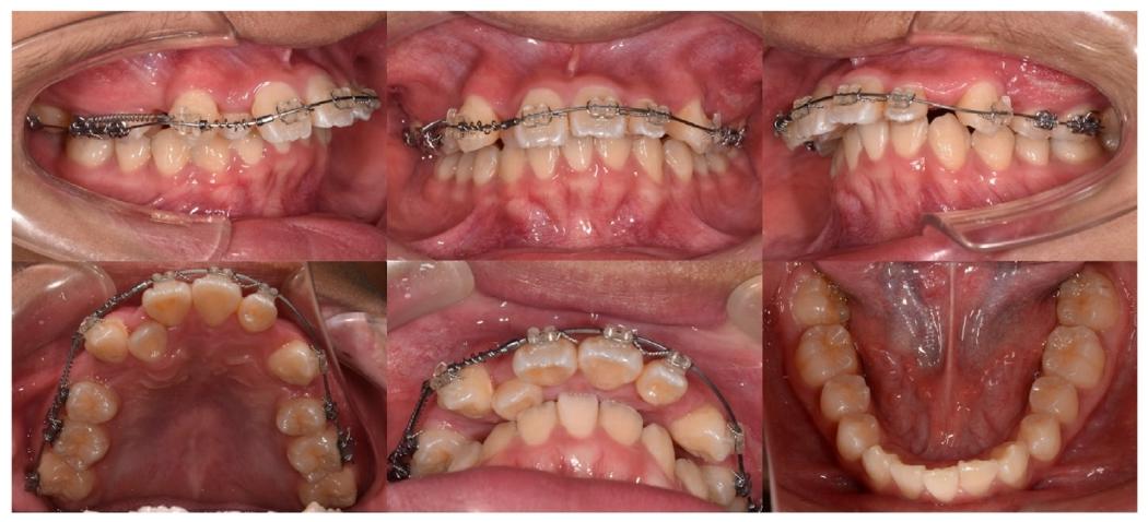 图5. Period of active treatment: the third months