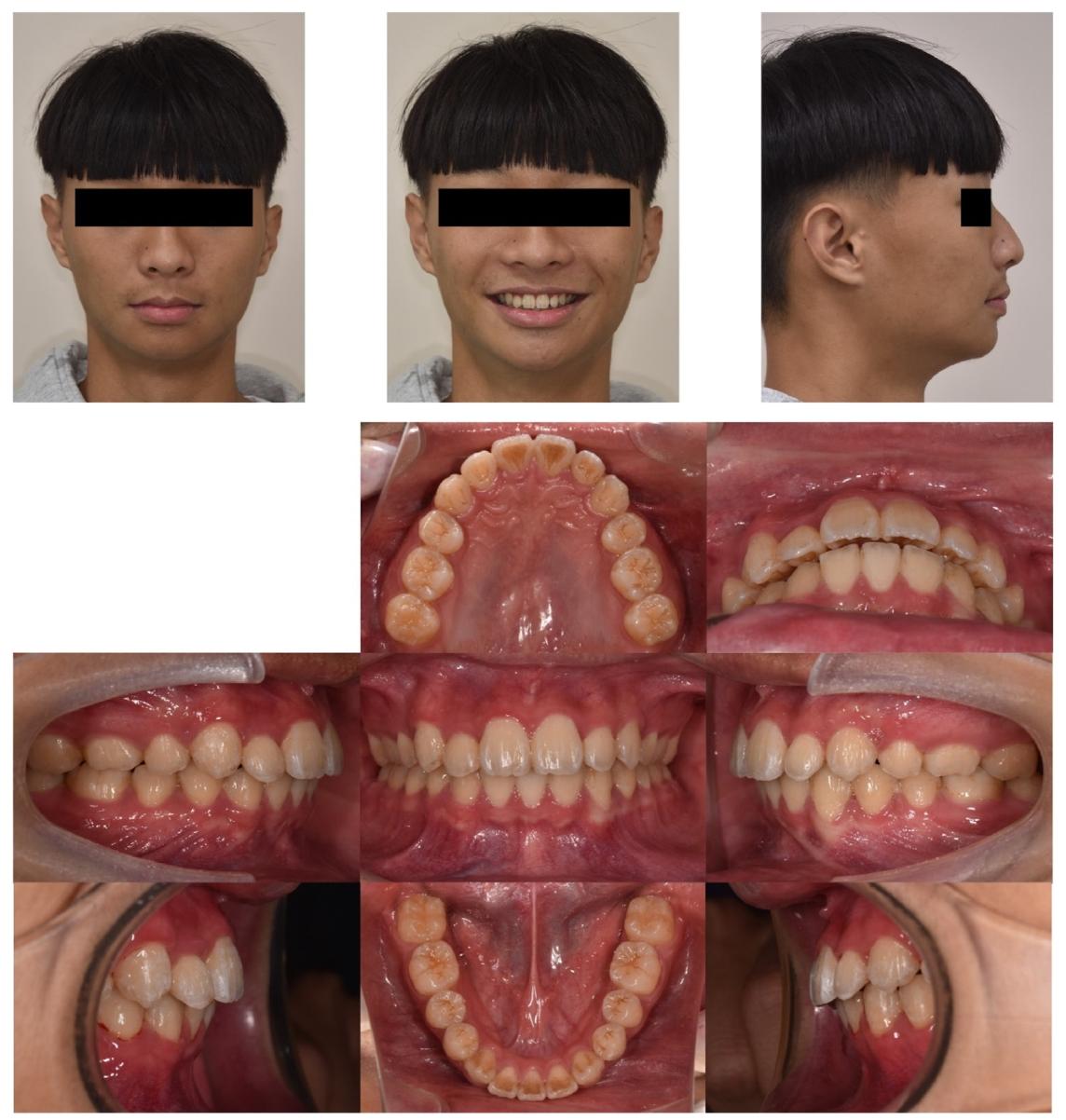 图8. Post-treatment facial and intraoral photographs